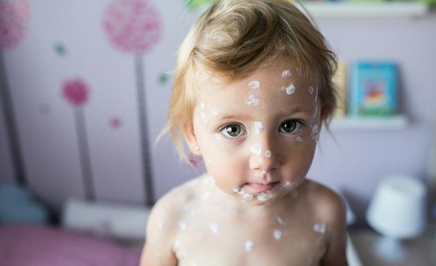 Un bébé avec une éruption cutanée sur le visage, portant une crème apaisante pour soulager l'irritation.