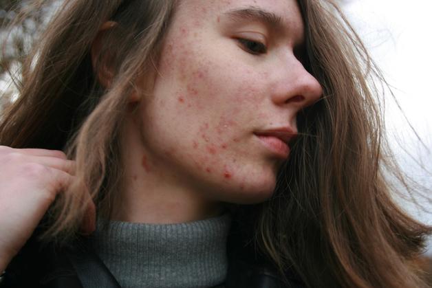 Femme montrant des signes d'acné grossesse sur son visage, mettant en évidence des boutons et des imperfections cutanées.