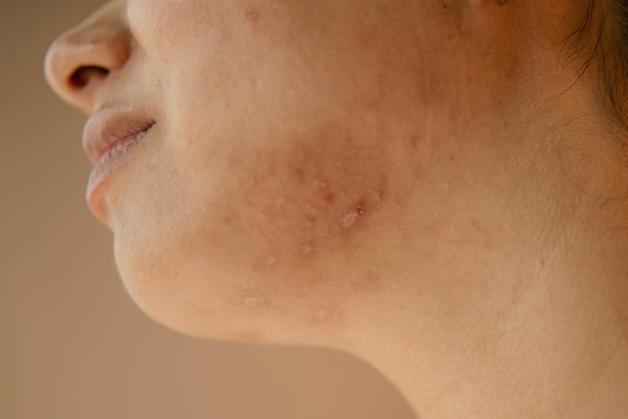 Femme présentant des signes d'eczéma grossesse sur le visage, avec des rougeurs et des lésions cutanées.