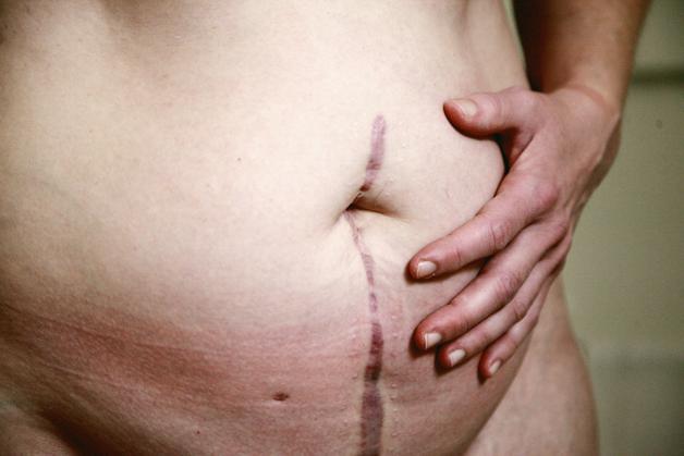 Image d'un ventre avec des vergetures grossesse, montrant les marques cutanées fréquemment observées pendant la grossesse.
